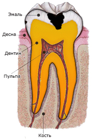 Средний кариес зуба